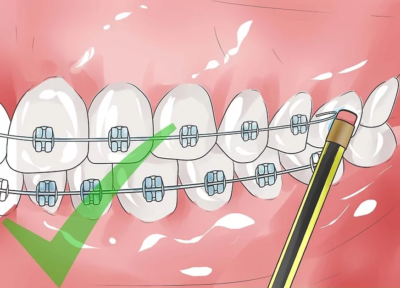 Fixing Wires - Braces